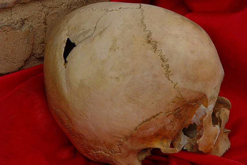 نخستين عمل جراحي مغز در تاريخ